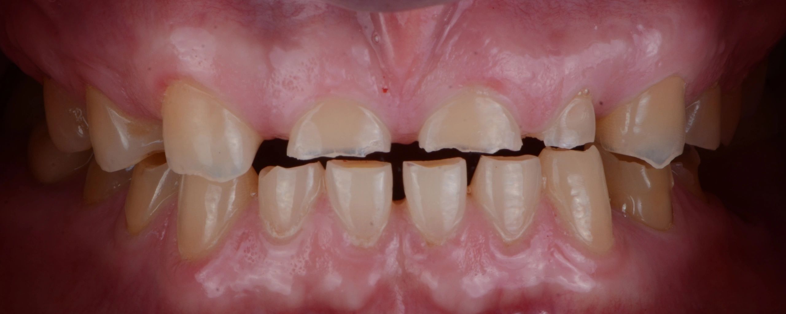 Tooth crowding dental photograph